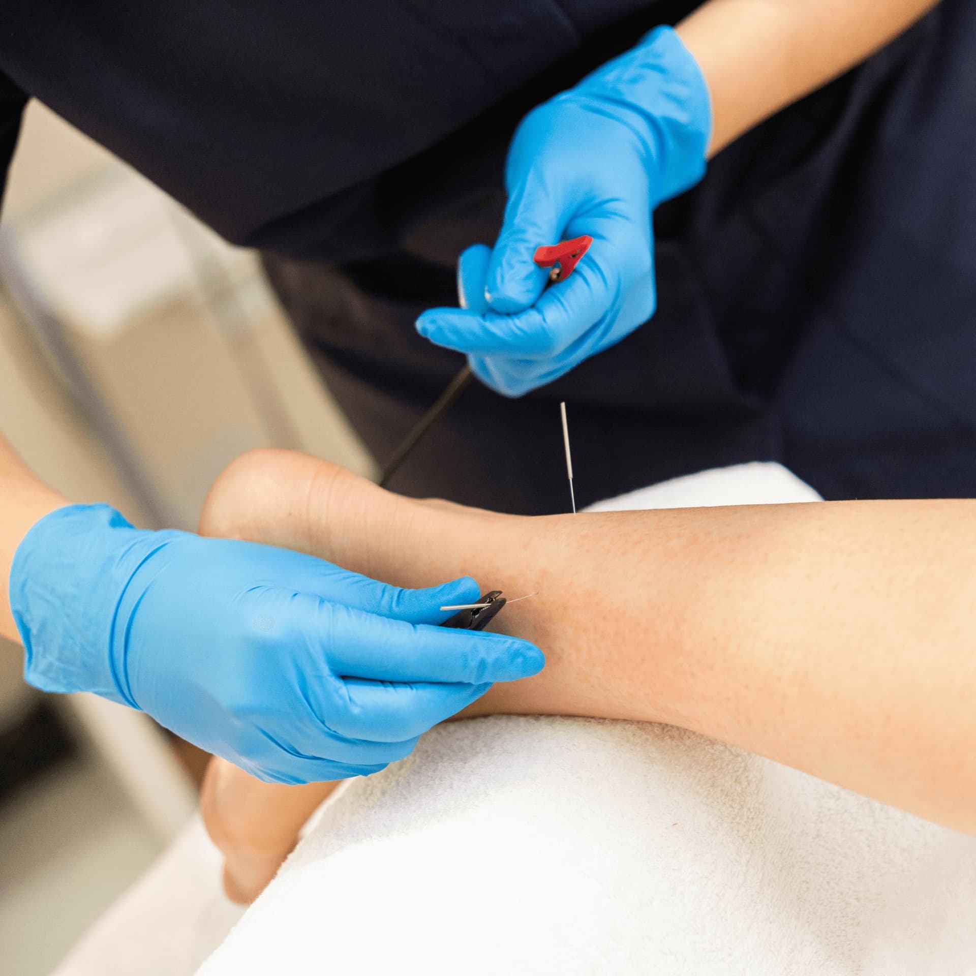 Therapist performing dry needling London therapy for muscle tension