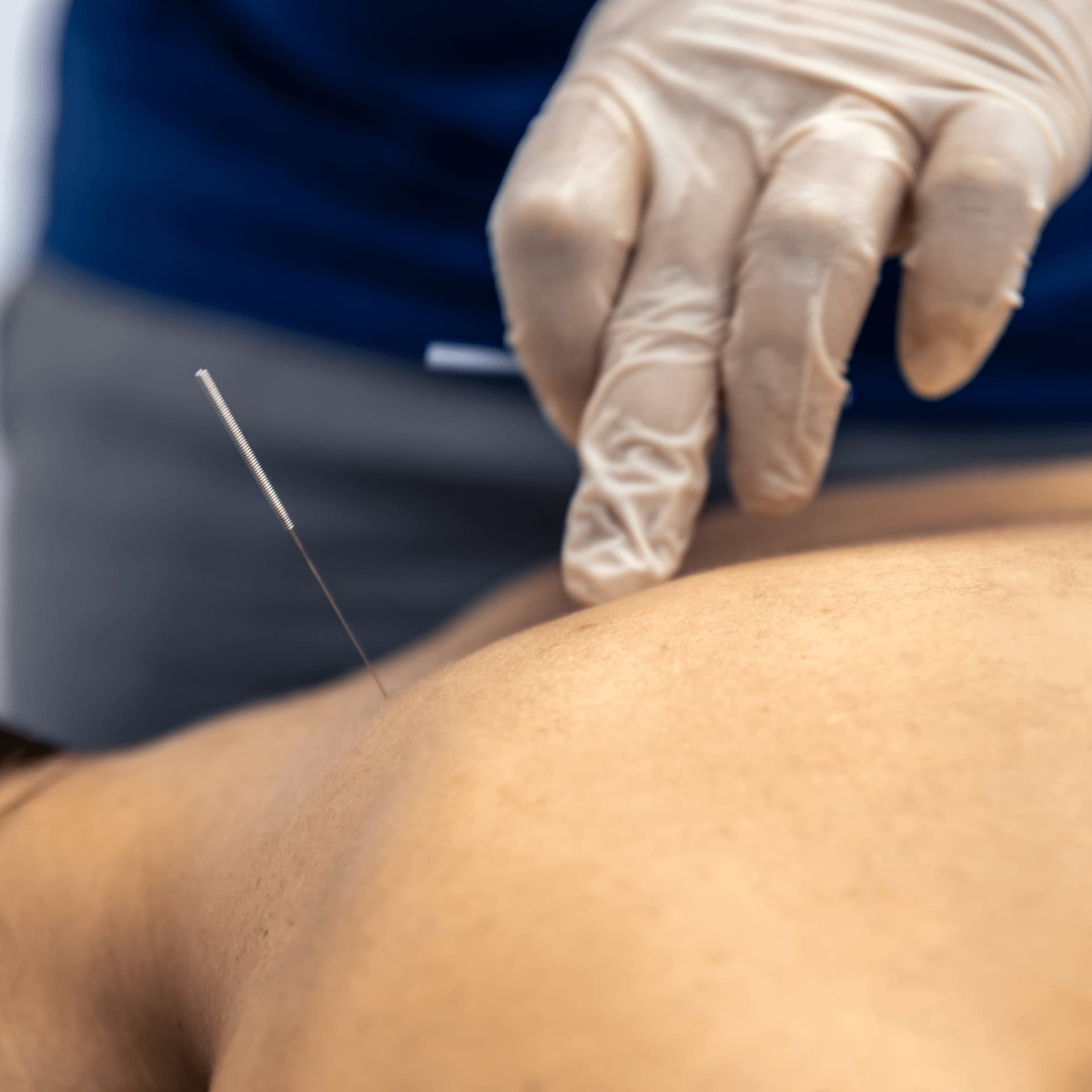 Physiotherapist performing dry needling therapy at Bodyfunction Clinic