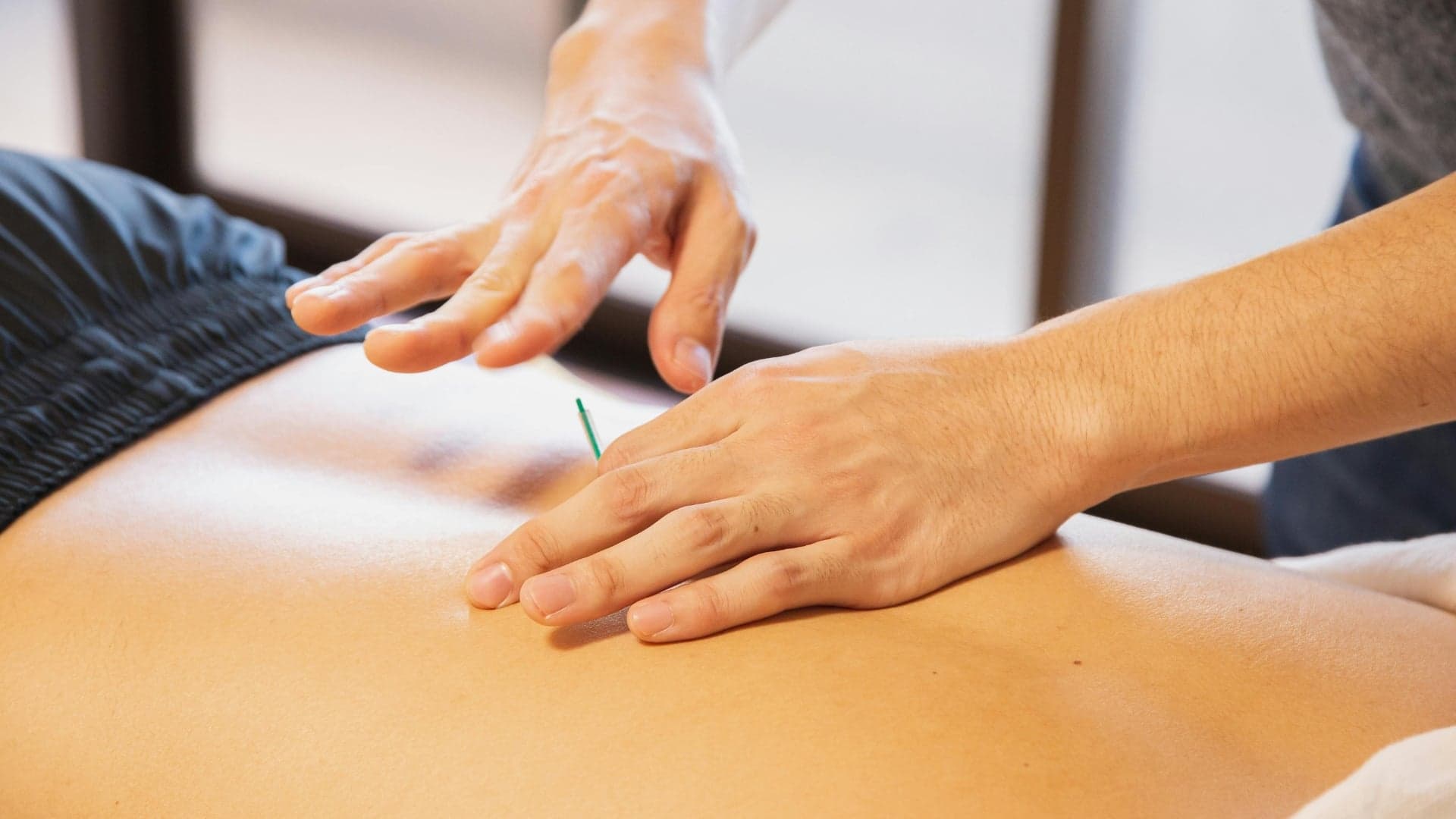 Acupuncture treatment in progress at an Islington clinic