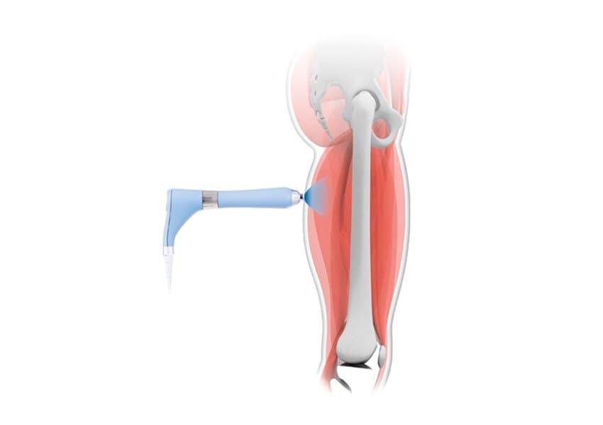 Illustration of a radial shockwave applicator directing pressure waves into the muscle and tendon of the thigh